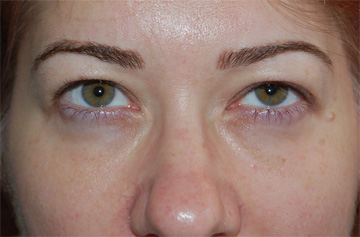 Facelift Before & After Image