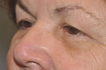 Facelift Before & After Image