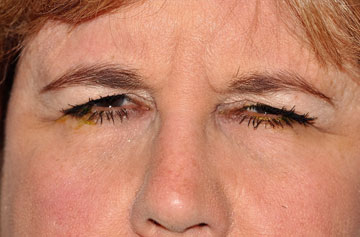 Facelift Before & After Image