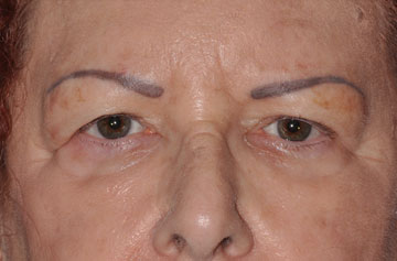 Facelift Before & After Image