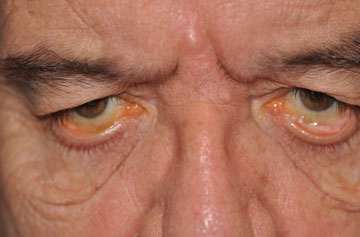 Facelift Before & After Image