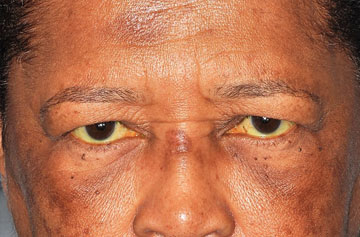 Facelift Before & After Image