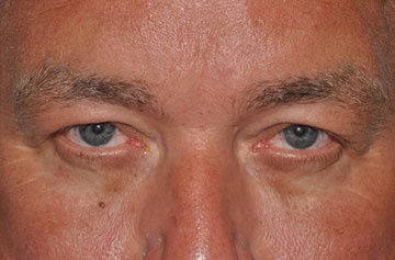 Facelift Before & After Image