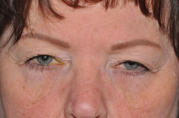 Facelift Before & After Image
