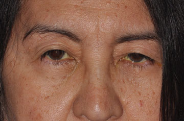 Facelift Before & After Image