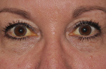 Facelift Before & After Image