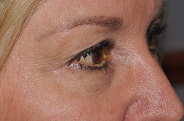 Facelift Before & After Image