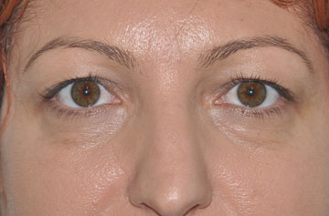 Facelift Before & After Image
