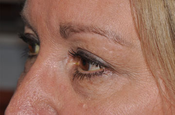 Facelift Before & After Image