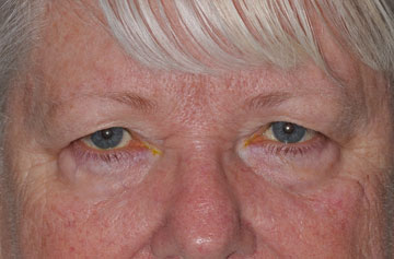 Facelift Before & After Image