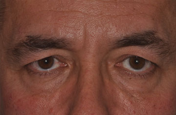 Facelift Before & After Image