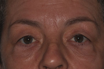 Facelift Before & After Image