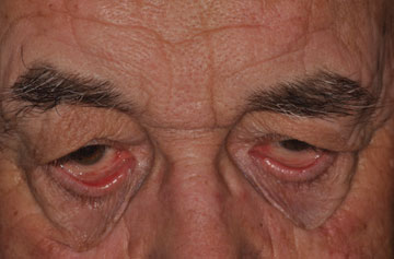 Facelift Before & After Image