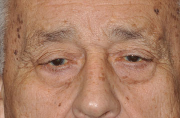 Facelift Before & After Image