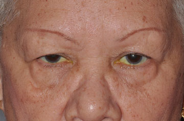 Facelift Before & After Image