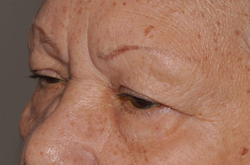 Facelift Before & After Image