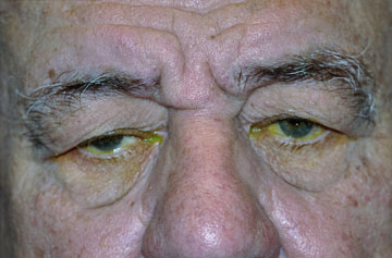 Facelift Before & After Image