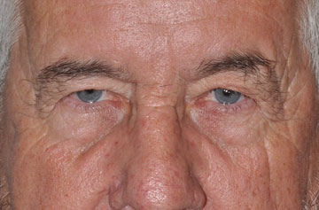 Facelift Before & After Image