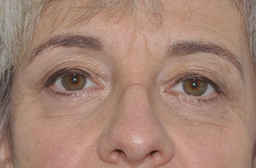 Facelift Before & After Image