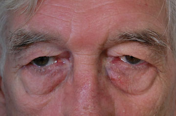 Facelift Before & After Image