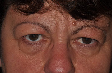 Facelift Before & After Image