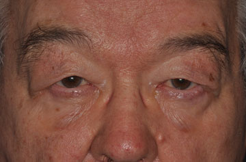Facelift Before & After Image