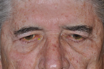 Facelift Before & After Image