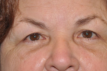 Facelift Before & After Image
