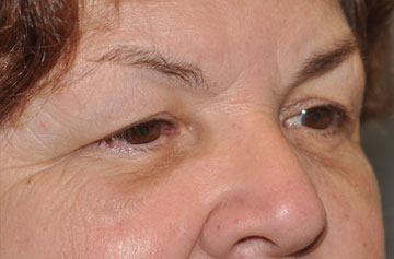 Facelift Before & After Image