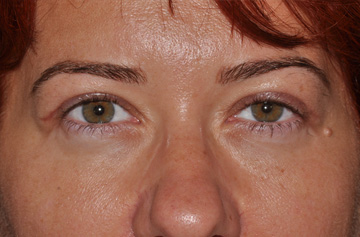 Facelift Before & After Image