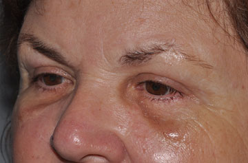 Facelift Before & After Image