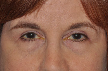 Facelift Before & After Image