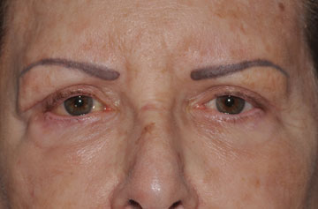 Facelift Before & After Image