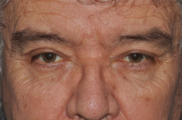 Facelift Before & After Image