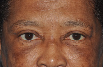 Facelift Before & After Image