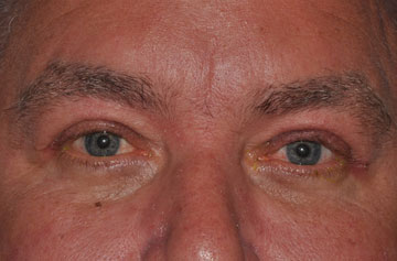 Facelift Before & After Image