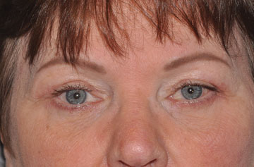 Facelift Before & After Image