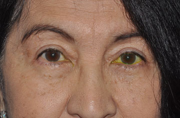 Facelift Before & After Image