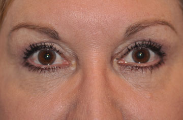 Facelift Before & After Image