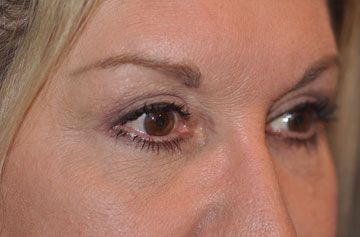 Facelift Before & After Image