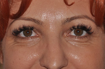 Facelift Before & After Image