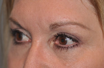 Facelift Before & After Image