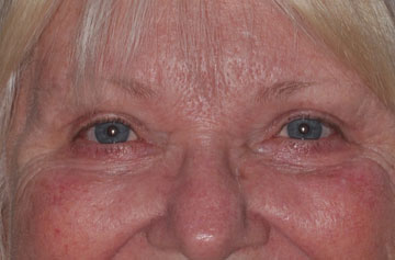 Facelift Before & After Image