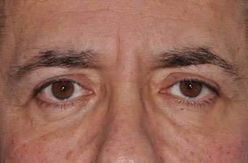 Facelift Before & After Image