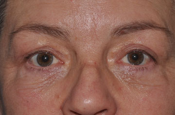 Facelift Before & After Image