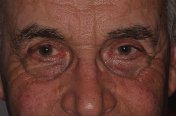 Facelift Before & After Image