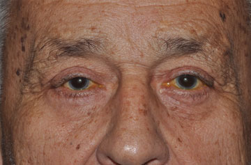 Facelift Before & After Image