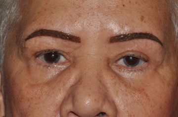 Facelift Before & After Image