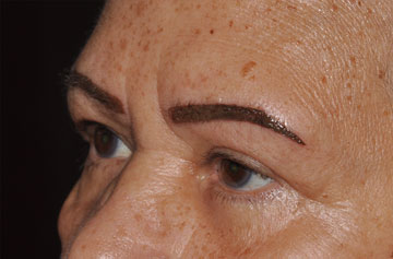 Facelift Before & After Image