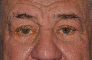 Facelift Before & After Image